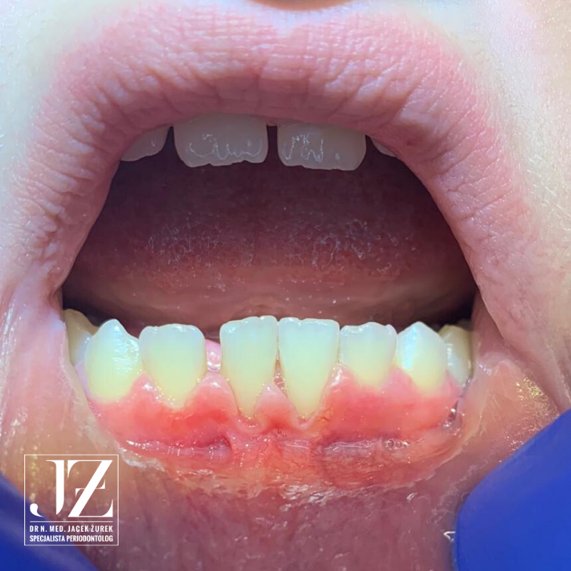 Read more about the article Leczenie ortodontyczne? Najpierw wizyta u periodontologa!